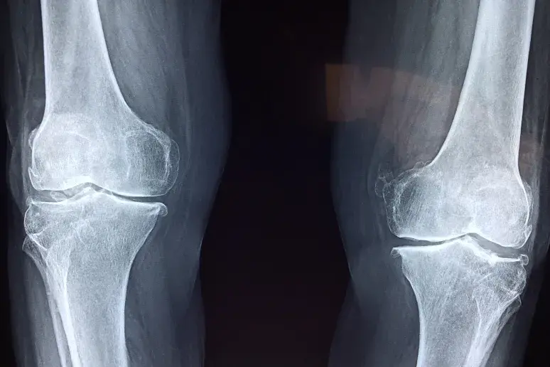 X-ray of Knees. Pixabay/Taokinesis