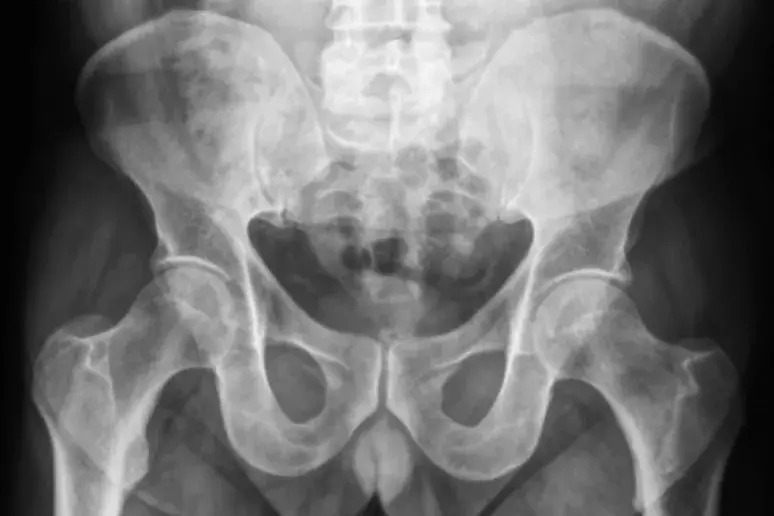 Metal-on-metal hip replacements may pose safety concerns